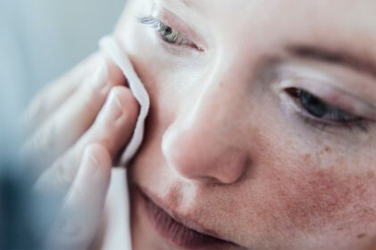 10 astuces pour atténuer la Rosacée