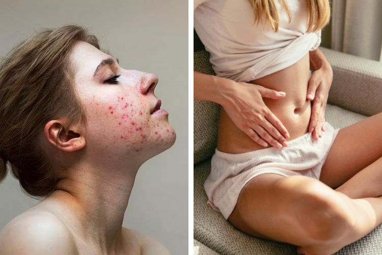 C'est quoi l'acné digestive ?