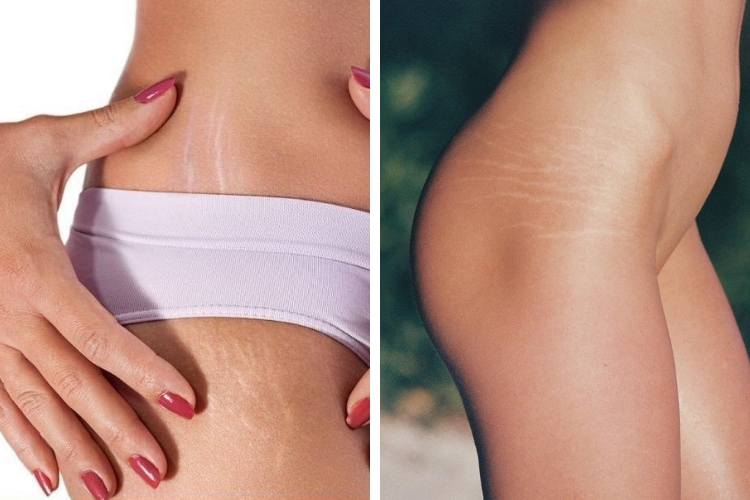 Comment bien traiter ses vergetures au laser ?