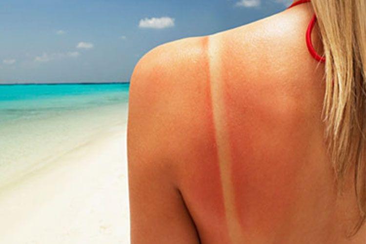 DIY : Astuces maison pour apaiser les coups de soleil