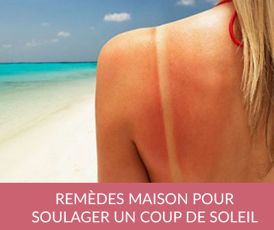 Astuces pour calmer un coup de soleil