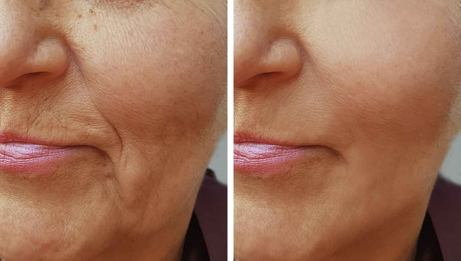 acide hyaluronique anti-âge