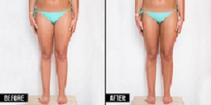 tontouring des cuisses